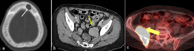 CT scans from a Myeloma Trial